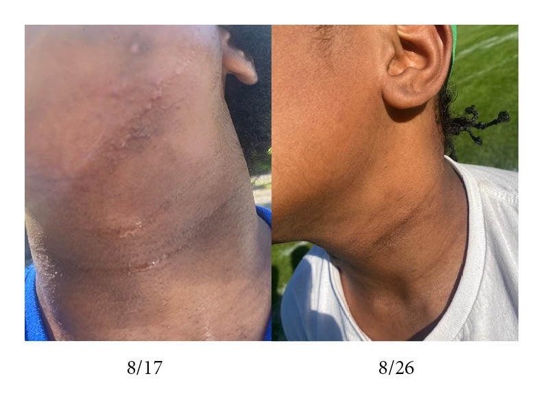 A side-by-side before-and-after comparison of a person's neck and ear area, showing skin healing or treatment progress. The left panel is dated 8/17 and shows more redness and irritation, while the right panel is dated 8/26 and shows significantly clearer skin.
