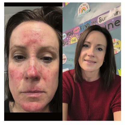 A split-screen before-and-after style comparison showing a woman's face. The left side shows severe facial redness, acne, and irritation, while the right side shows her smiling with clear, healed skin.