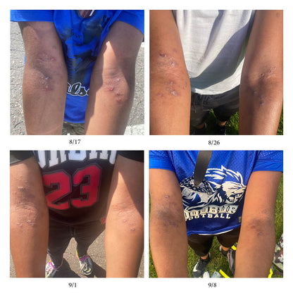 A four-panel collage showing close-up views of a person's upper arms and thighs with multiple healed skin scars or marks. Each panel includes a date stamp and a small photo caption, with the person wearing blue and gray tops in outdoor settings.