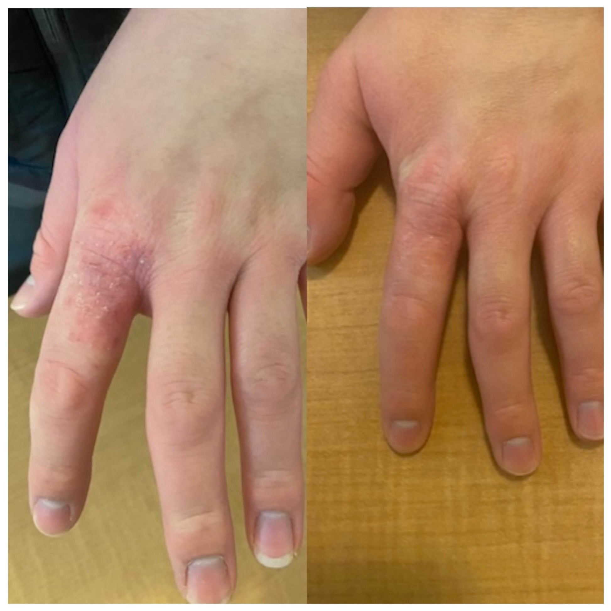 A side-by-side comparison of a human hand, showing skin irritation and redness on the left, and a clearer, healthier-looking hand on the right, placed on a wooden surface.